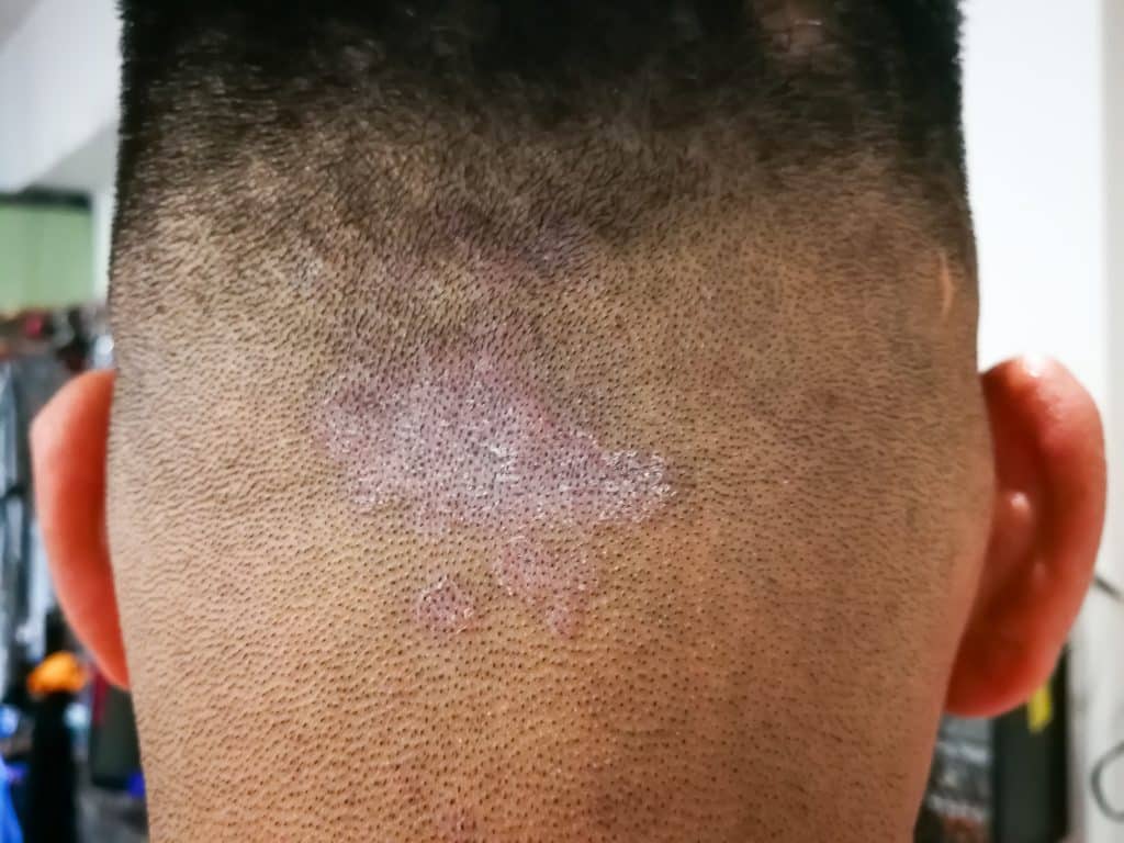 Detailed view of thickened psoriasis plaques on skin
