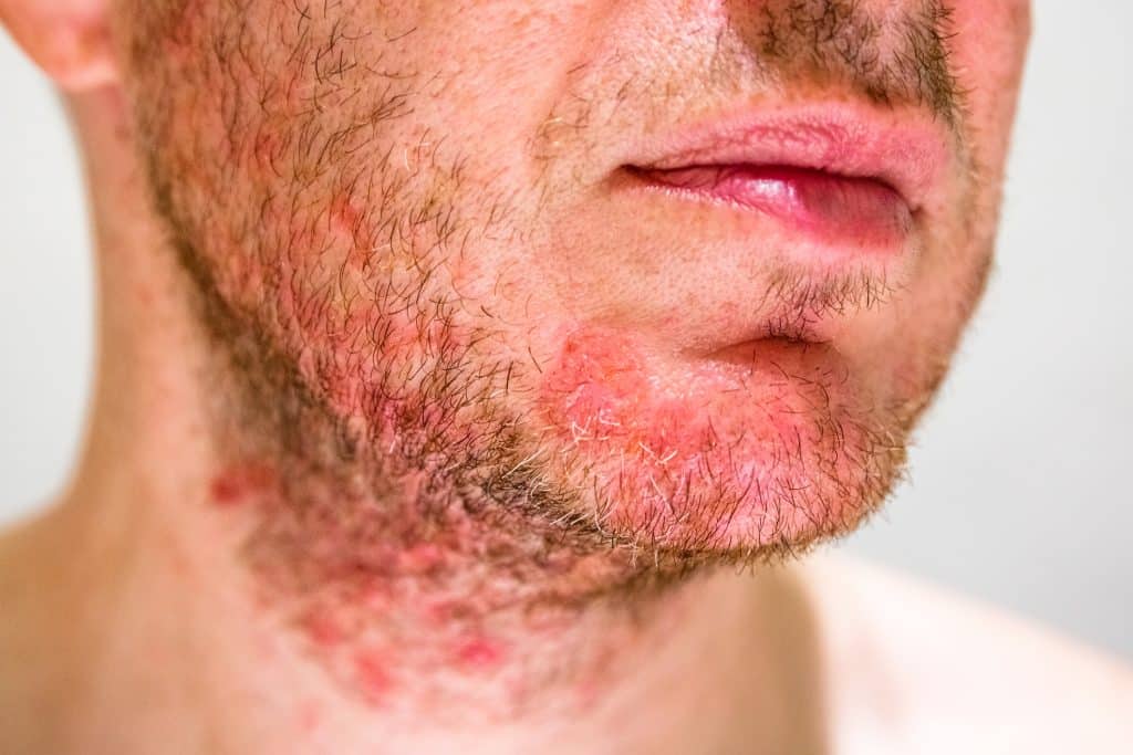 ​facial dermatitis, face rash treatment, skin irritation face, eczema on face, facial redness causes, dermatitis on chin,