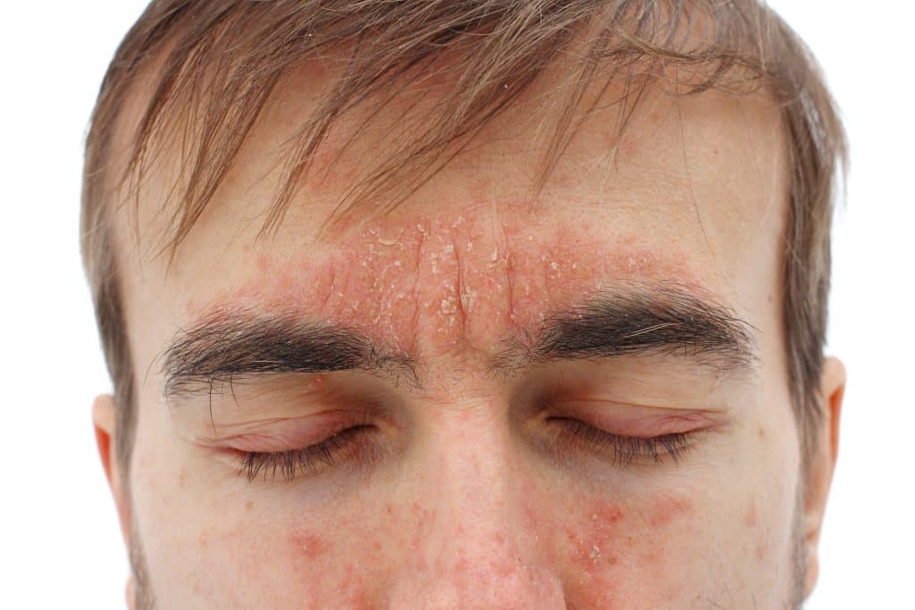 Close-up of a man’s forehead with irritated skin caused by dermatitis