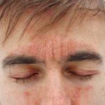 Red, inflamed facial skin showing signs of eczema on cheeks and forehead