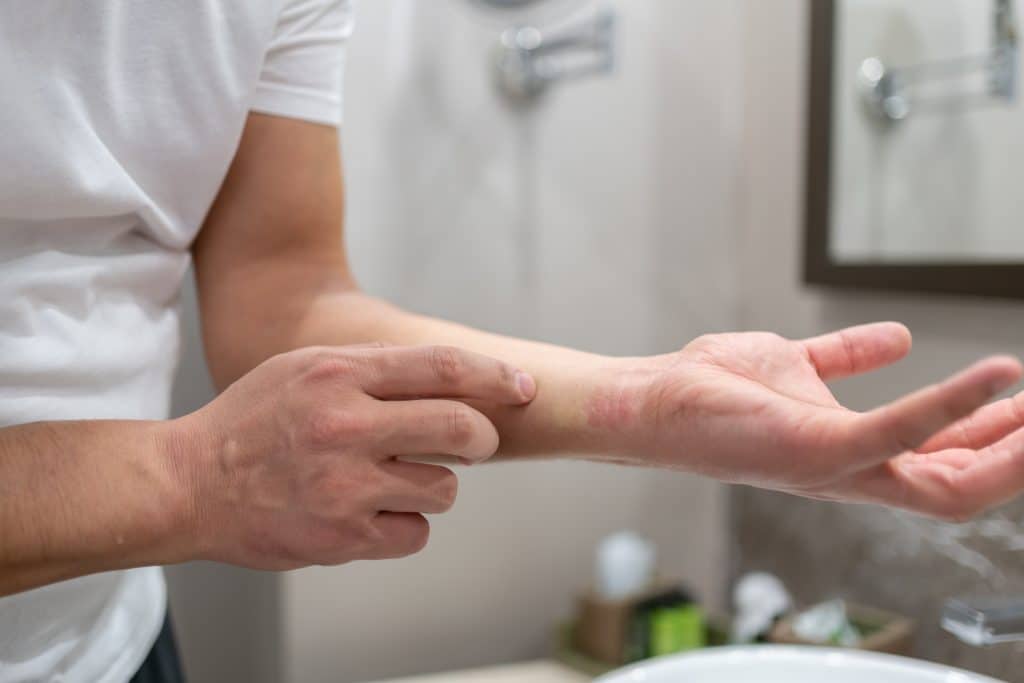 ​cream for eczema, eczema cream, best eczema cream, natural eczema cream, eczema cream for kids, moisturizing eczema cream, Best Atopic Eczema Cream,