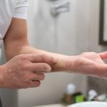 Allergic reaction to atopic dermatitis on the hands