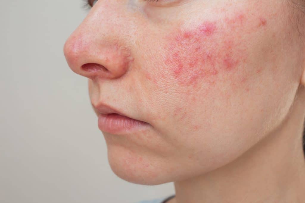 Close-up of facial skin showing redness and irritation from dermatitis