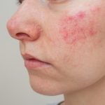 Facial eczema flare showing redness and dry patches on cheeks