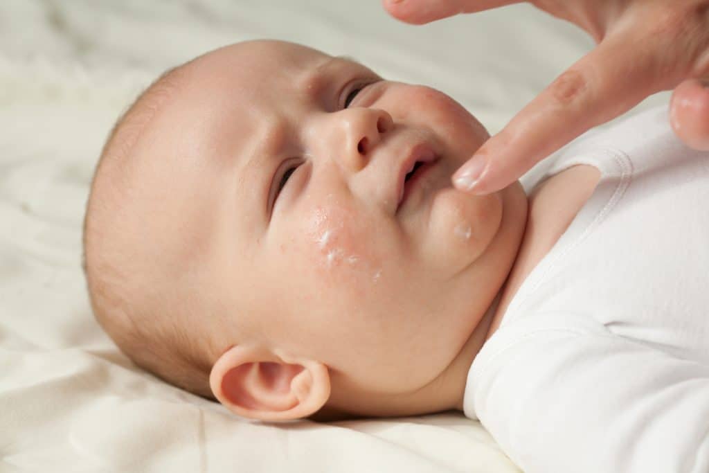 gentle cream for atopic dermatitis in babies