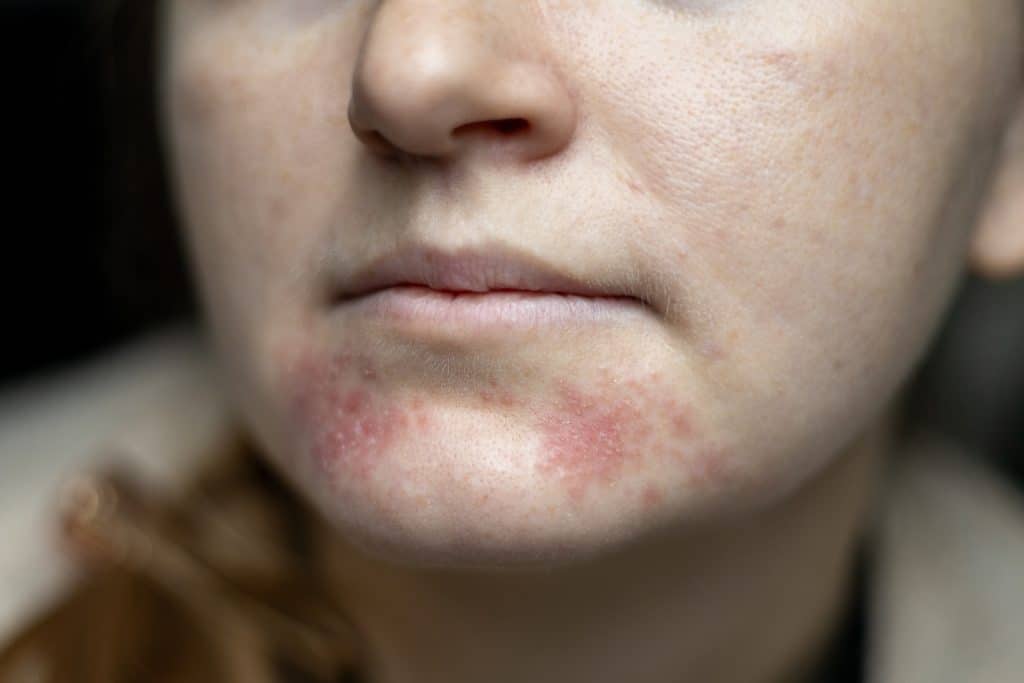 Facial eczema flare-up showing redness and irritation on sensitive skin