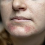 best atopic dermatitis cream, Eczema Flare-Up on Face