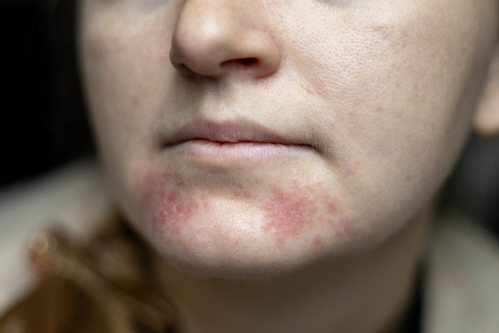 Close-up of facial skin with visible dermatitis redness and irritation