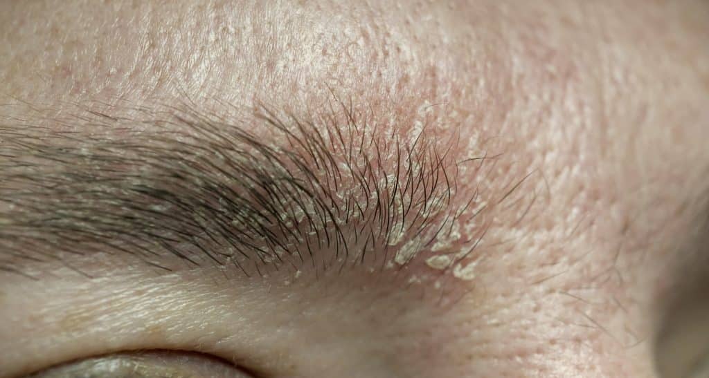 drematitis cream, eczema cream, skin rash treatment, anti-itch cream, dermatitis relief cream,dermatitis care, dermatitis on face,