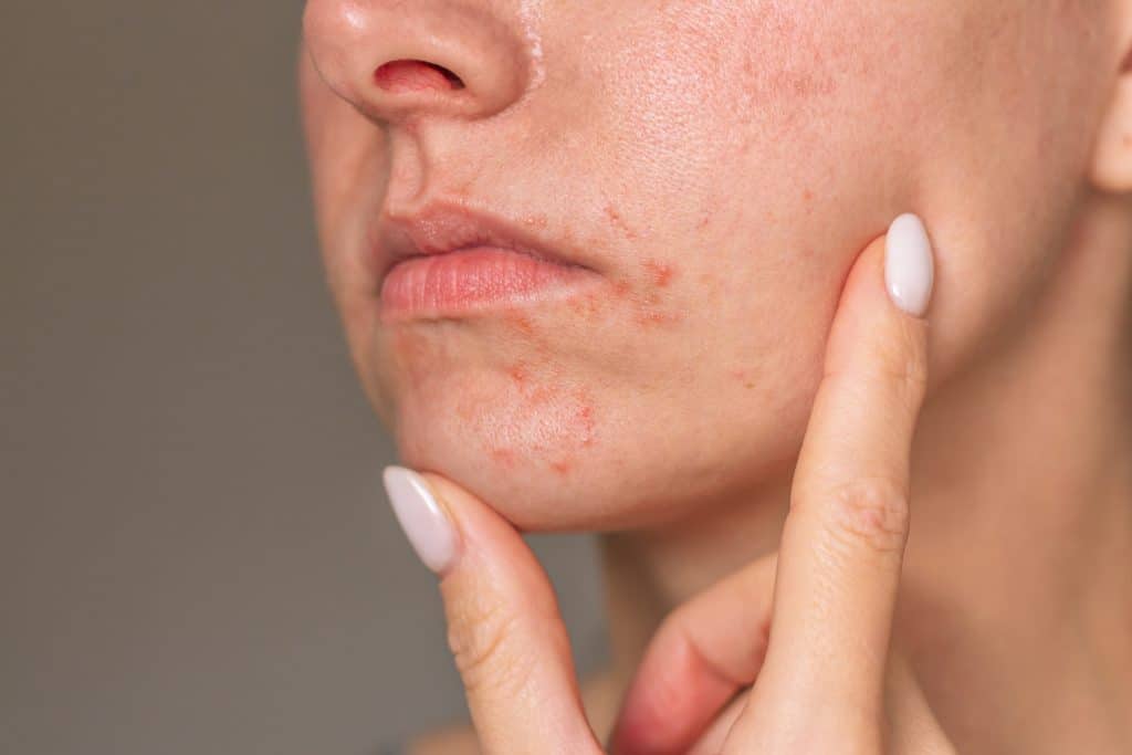 Facial skin with visible redness and dry patches due to dermatitis