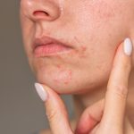 Face of a woman with acne