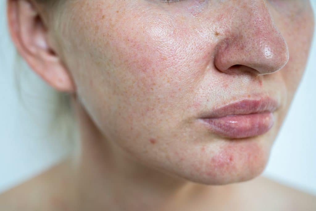 ​facial dermatitis, face rash treatment, skin irritation face, eczema on face, facial redness causes, dermatitis on chin,