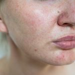 Facial Dermatitis.