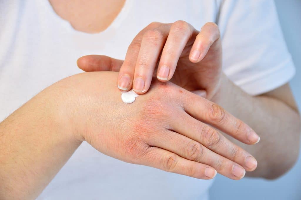 atopic dermatitsi on hands