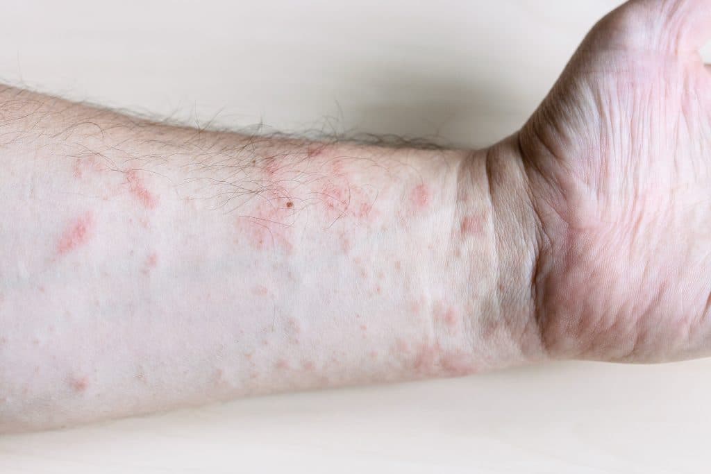 Allergic reaction rash on arm