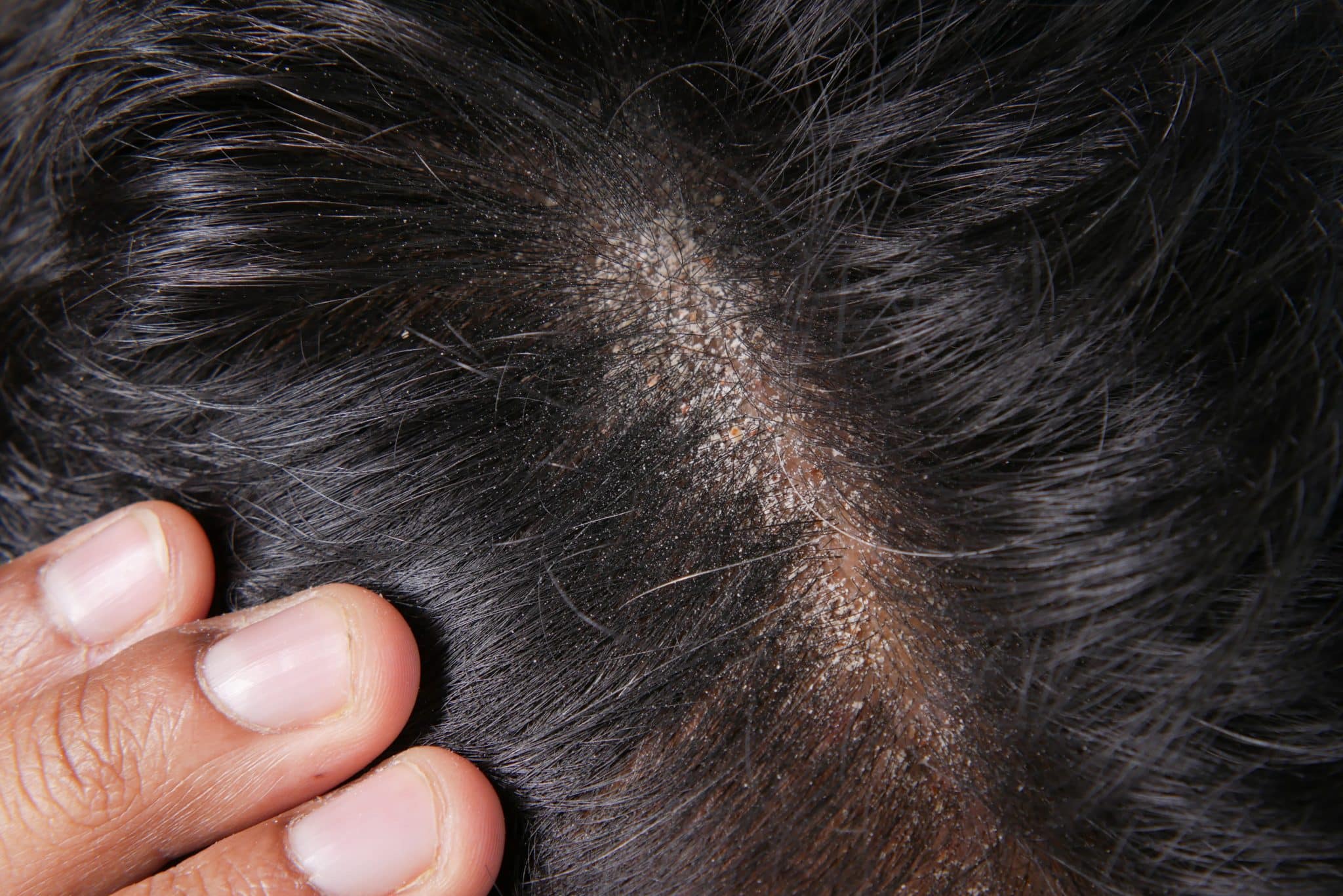 Close-up of a man examining silver scales on the scalp