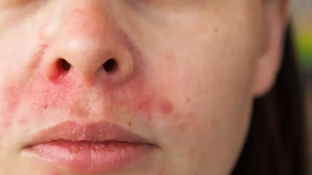 perioral dermatitis, skin rash around mouth, facial rash treatment Ireland, perioral dermatitis causes, gentle skin care for rash, perioral dermatitis nose