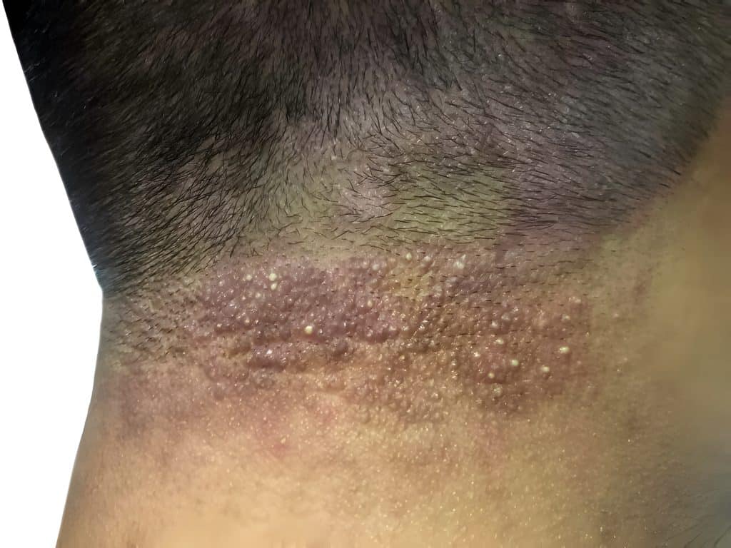 ​seborrheic dermatitis shampoo, best shampoo for seborrheic dermatitis ireland, dandruff shampoo for sensitive scalp ireland, medicated shampoo seborrheic dermatitis, anti-itch shampoo ireland, Shampoo Soothes Seborrheic Dermatitis