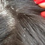seborrheic dermatitis shampoo, best shampoo for seborrheic dermatitis, seborrheic dermatitis treatments, antifungal shampoo for scalp, natural remedies for seborrheic dermatitis, The Best Shampoos for Seborrheic Dermatitis and Psoriasis, best shampoo for Seborrheic dermatitis, which shampoo is best for seborrheic dermatitis, this shampoo for seborrheic dermatitis,