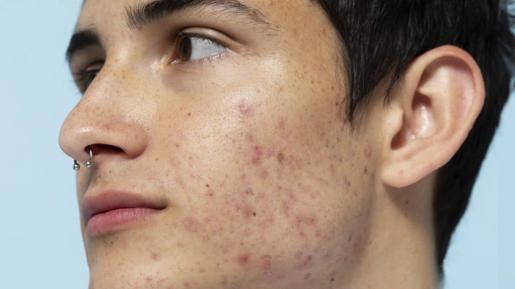 Side profile showing textured skin and acne scarring