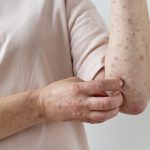 skin rash,