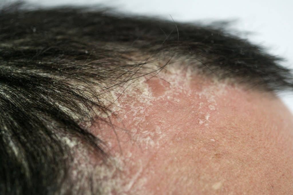 Seborrhoeic Eczema Shampoo