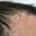 best shampoo for scalp psoriasis