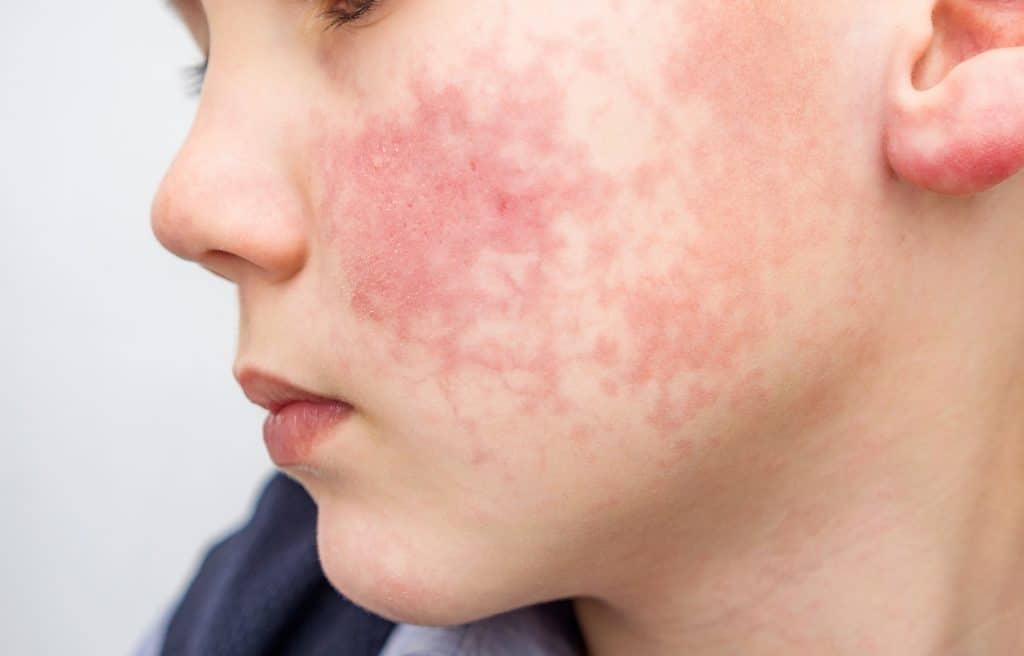 ​Dry, red eczema patches on cheeks and chin