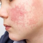 Boy with a rash on his cheek