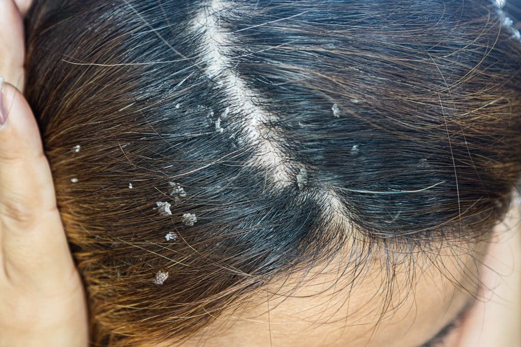scalp psoriasis shampoo,