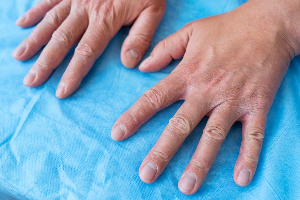 Medication to Treat Psoriatic Arthritis, Psoriatic Arthritis,