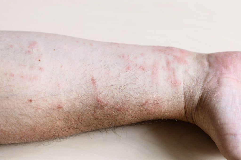 dermatitis on arm photo