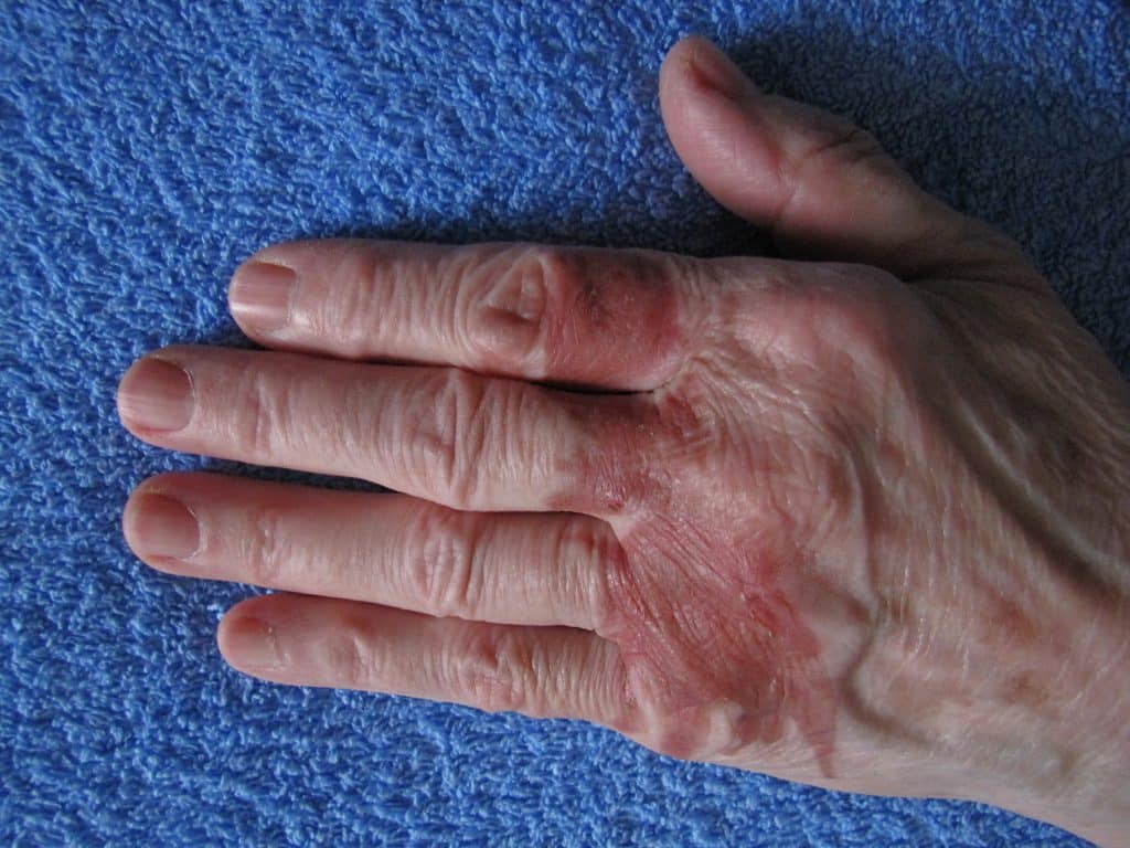 Psoriatic Arthritis Treatments