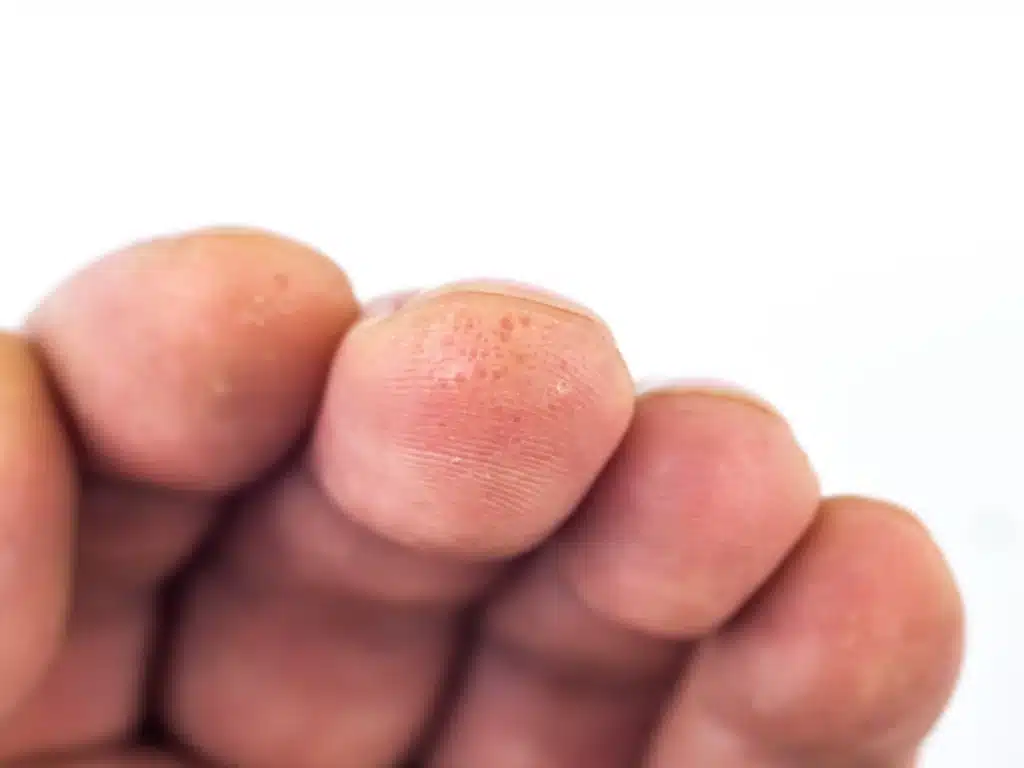 dyshidrotic eczema on finger tips