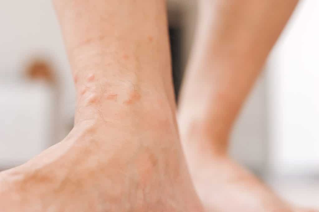 Dyshidrotic Eczema treatment, skin care for dyshidrotic eczema, dyshidrotic eczema natural remedies, best creams for dyshidrotic eczema, dyshidrotic eczema triggers