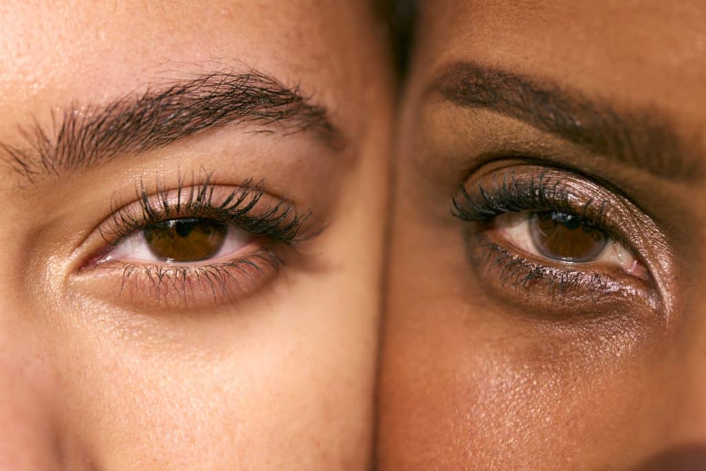 Close-up of eyes with dry, irritated eyelid skin