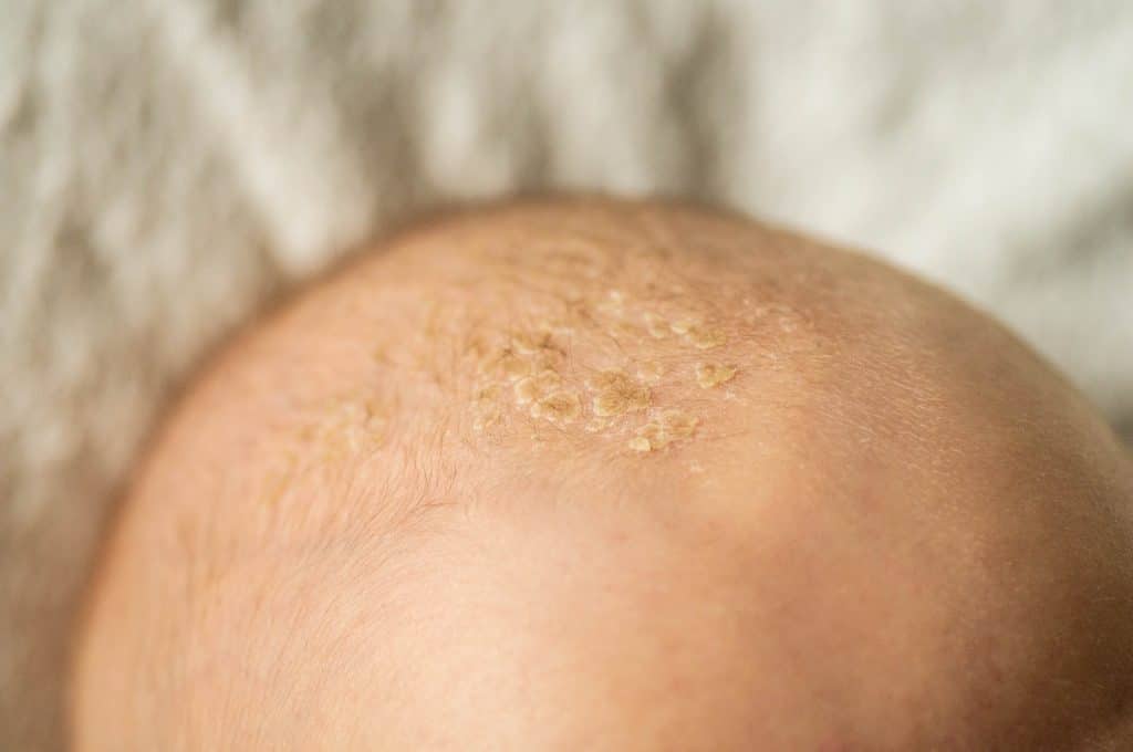 seborrheic dermatitis shampoo, best shampoo for seborrheic dermatitis, seborrheic dermatitis treatments, antifungal shampoo for scalp, natural remedies for seborrheic dermatitis, Seborrheic Dermatitis on the Scalp