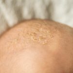 Seborrheic Dermatitis on the Scalp, ​dermatitis, eczema, skin rash, itchy skin, allergic reaction,