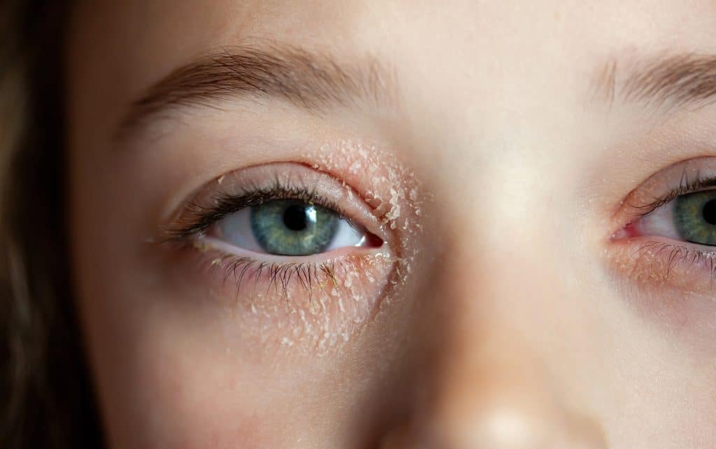 Red, irritated eyelid skin consistent with dermatitis