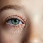 Eyelid Dermatitis Triggers, how to treat eyelid dermatitis,