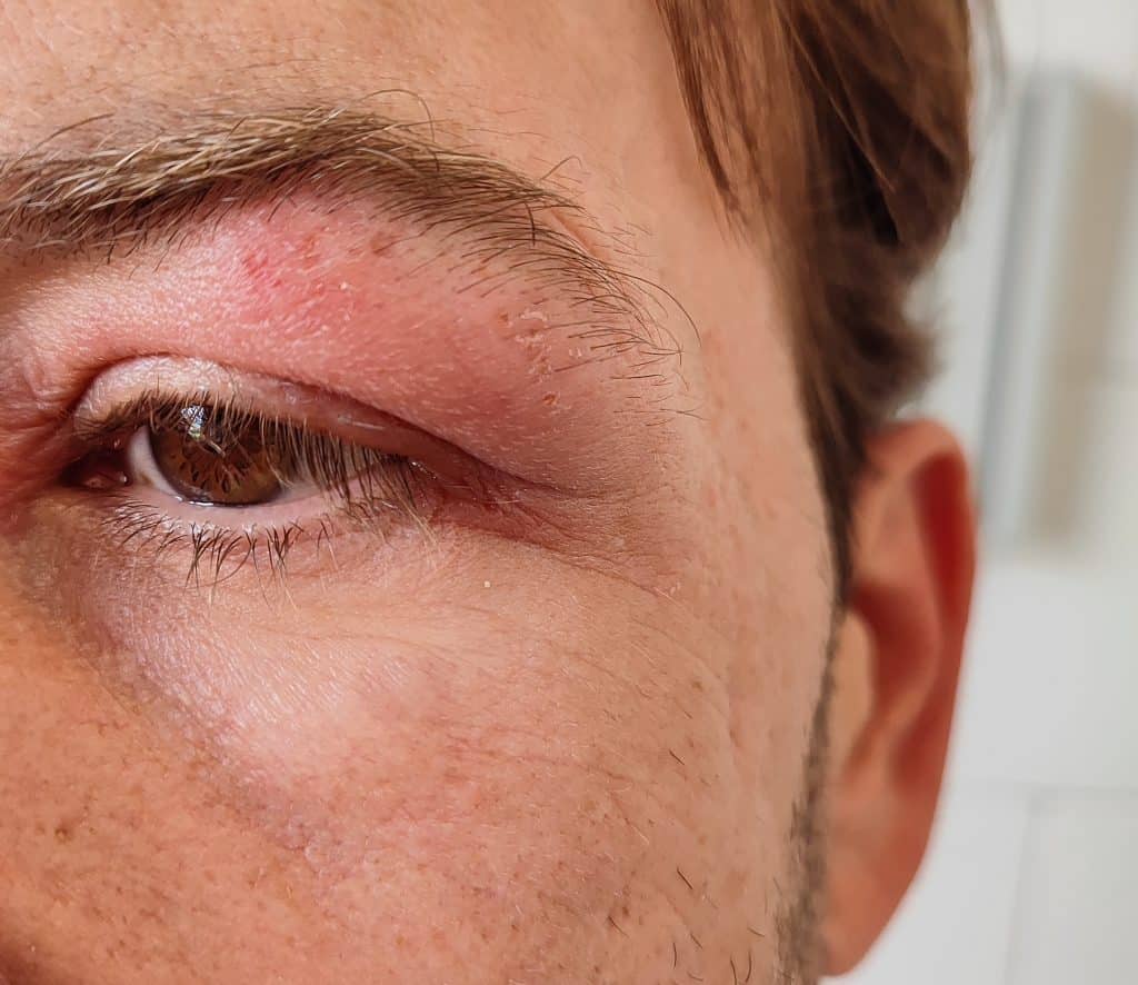 Man touching his irritated eyelid showing redness and inflamed skin around the eye