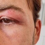 dermatitis on eyelid
