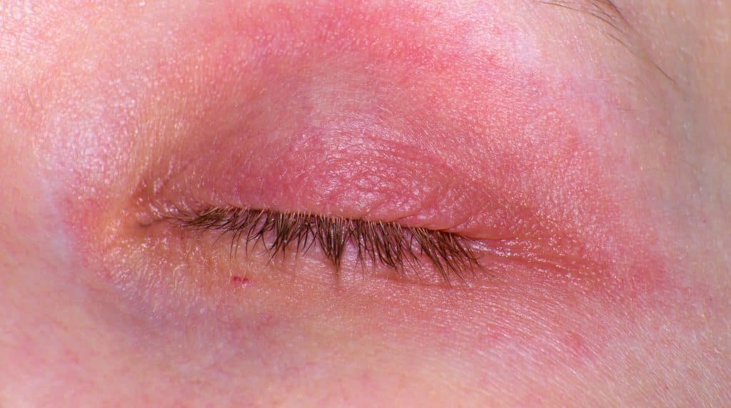 eczema on eyelid skin showing redness and irritation