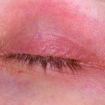 ​eyelid eczema, eyelid dermatitis, eyelid rash, dry eyelids, irritated eyelids,