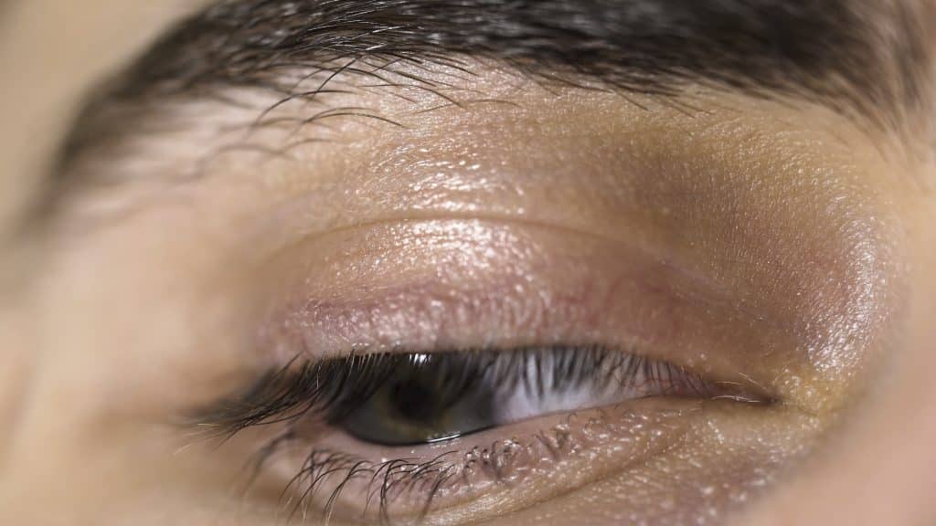 Eyelid eczema affecting delicate skin around the eye