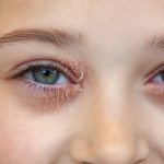 eyelid eczema,