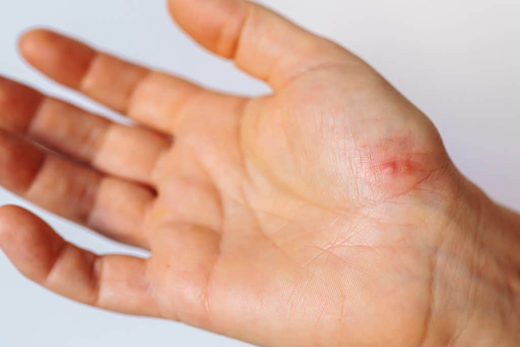common wart on the palm of a woman's hand