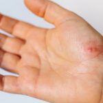 cream for warts,