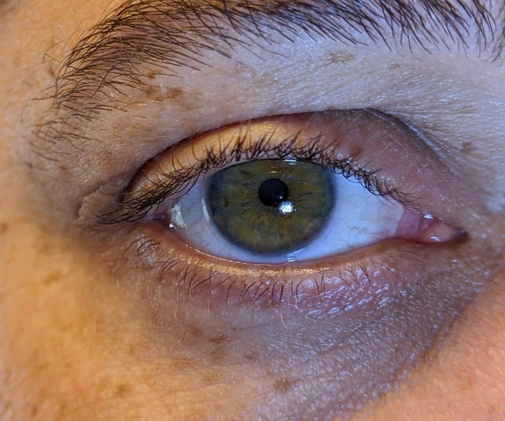 ​eyelid eczema, eyelid dermatitis, eyelid rash, dry eyelids, irritated eyelids