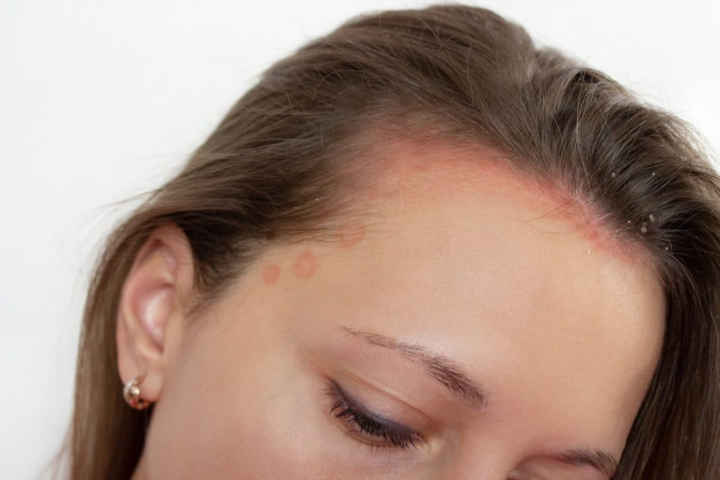 ​scalp healer, scalp treatment, hair scalp care, itchy scalp relief, scalp repair cream, psoriasis of scalp shampoo, ​scalp psoriasis shampoo, best shampoo for scalp psoriasis, moisturising shampoo for scalp psoriasis, medicated scalp psoriasis shampoo, natural shampoo for scalp psoriasisShampoo for Scalp Psoriasis,
